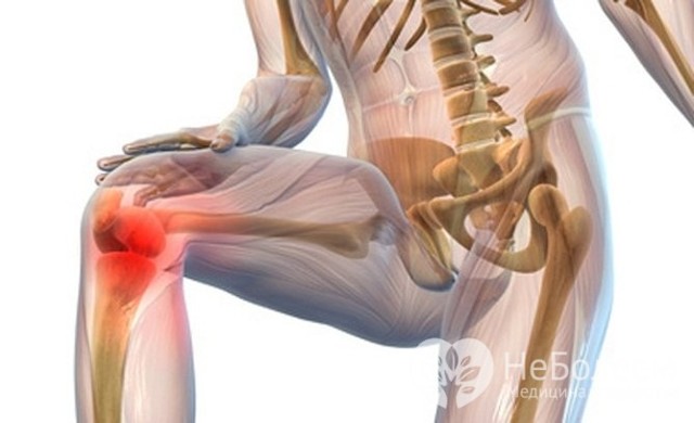 Артрит - симптомы, причины, лечение заболевания