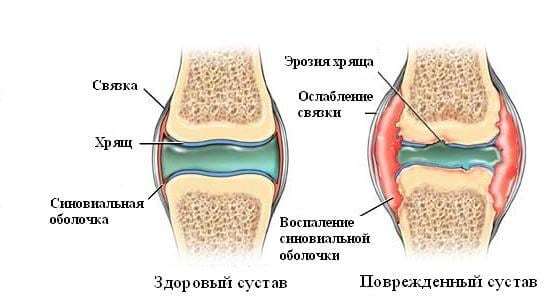 Хруст в суставах причины и лечение — Суставы