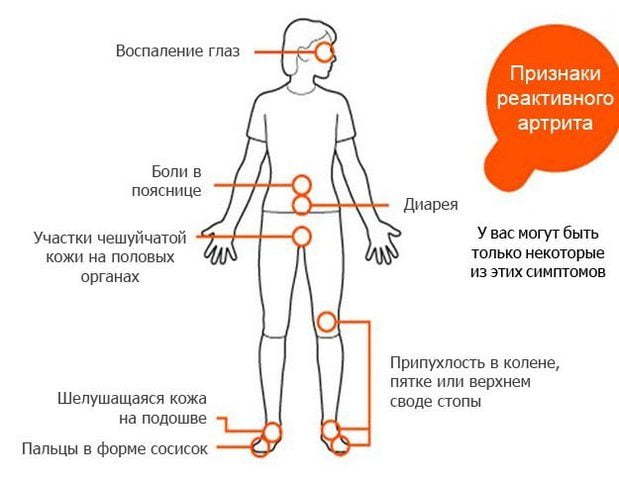 Реактивный артрит: симптомы и лечение