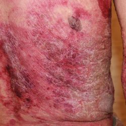 Псориаз у взрослых: фото, признаки, симптомы и лечение