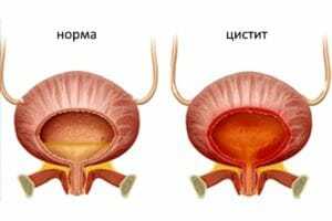 Больно писать мужчине или женщине: основные причины проблем при мочеиспускании, особенности лечения