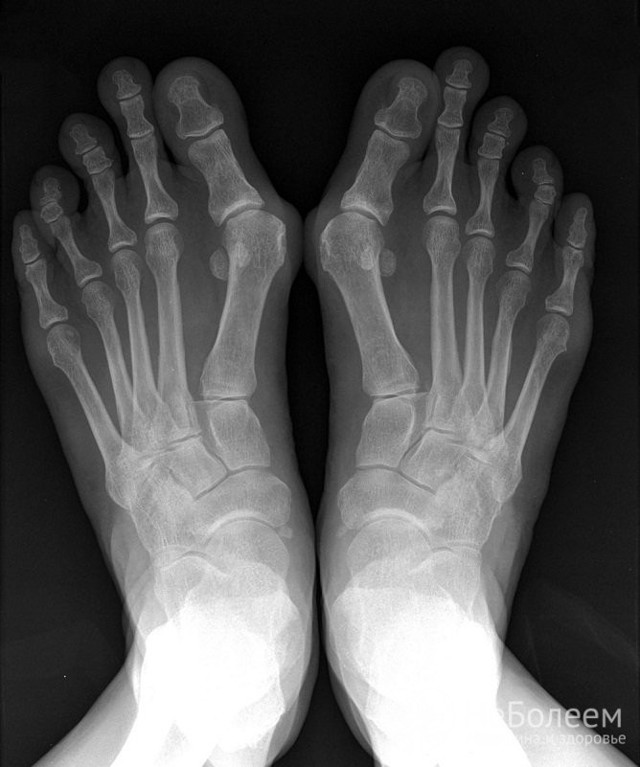 Артрит - симптомы, причины, лечение заболевания