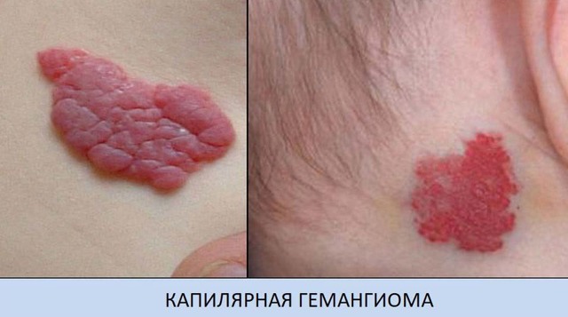 Гемангиома, что это такое, причины, симптомы и лечение