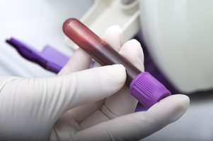 Свертываемость крови норма у женщин при беременности - Все про гипертонию