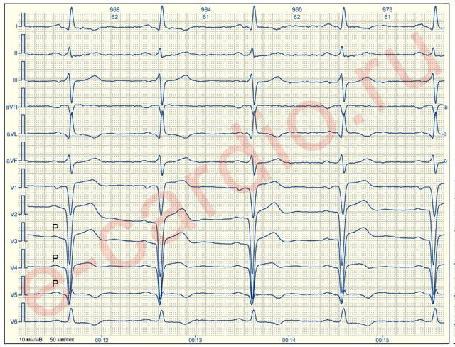 Рубцовые изменения — E-Cardio