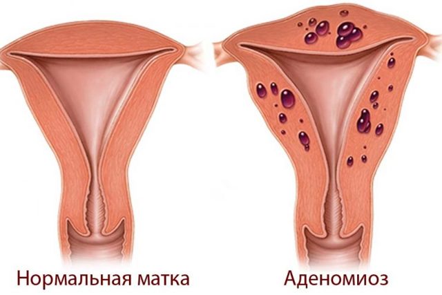 Аденомиоз матки и беременность: можно ли забеременеть, симптомы, диагностика, лечение, отзывы
