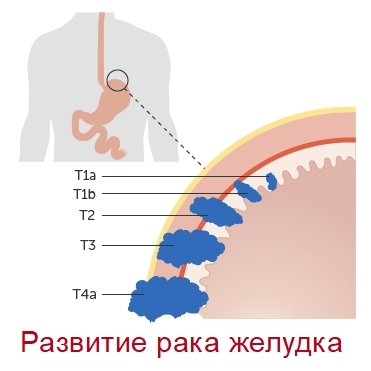Рак желудка 4 стадии - симптомы, выживаемость и другие особенности