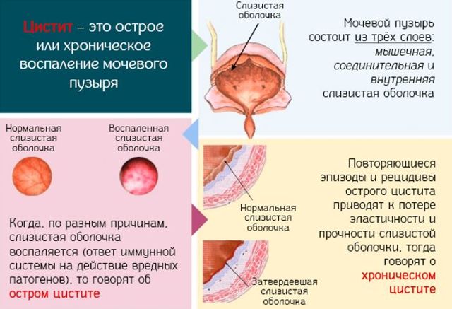 Цистит у мужчин - виды, причины, симптомы и лечение