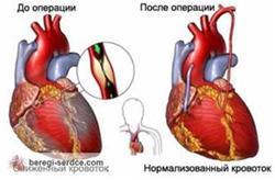 Самые опасные заболевания сердца