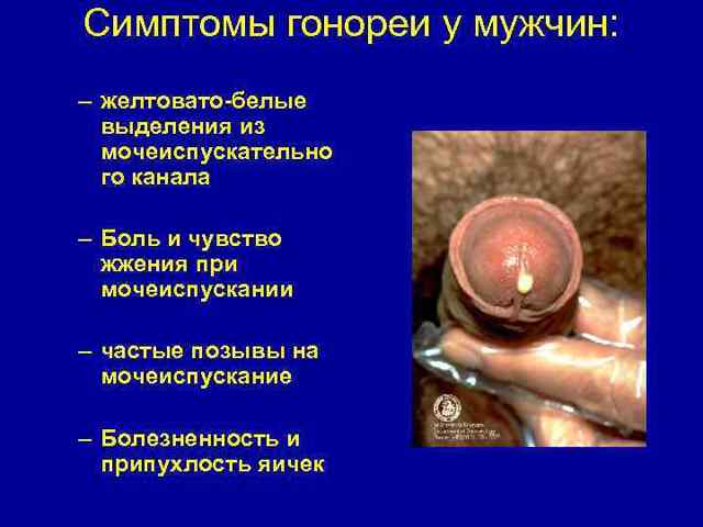 Гонорея у мужчин и женщин: симптомы, диагностика, лечение