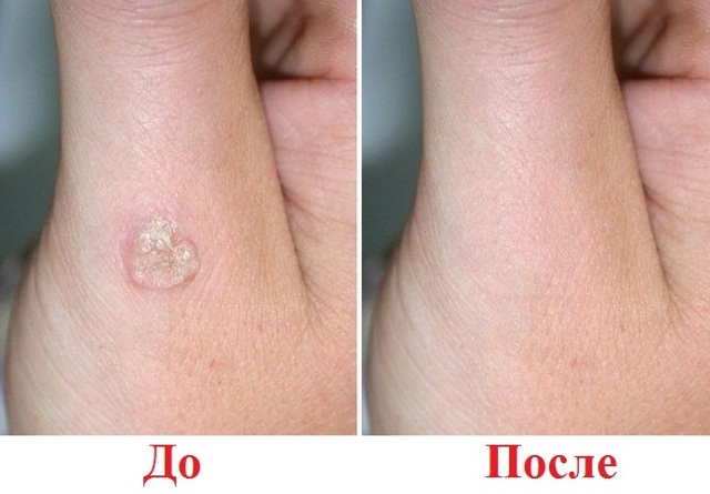 Ляписный карандаш от папиллом, инструкция по применению и отзывы
