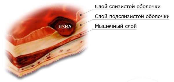 Язва двенадцатиперстной кишки: симптомы и лечение