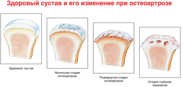 Пиаскледин 300 - инструкция по применению, описание, отзывы пациентов и врачей, аналоги