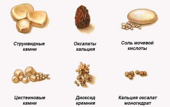 Камни в почках симптомы у женщин