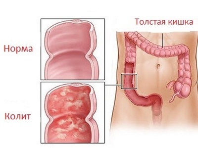Энтероколит у взрослых: симптомы и лечение