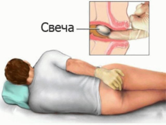 Ихтиоловые свечи при геморрое: инструкция по применению и отзывы