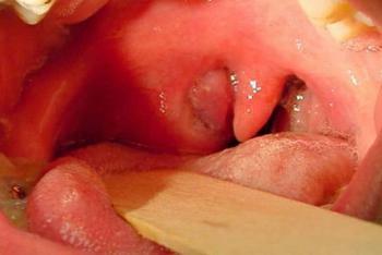 Аквалор для горла: инструкция по применению спрея для детей