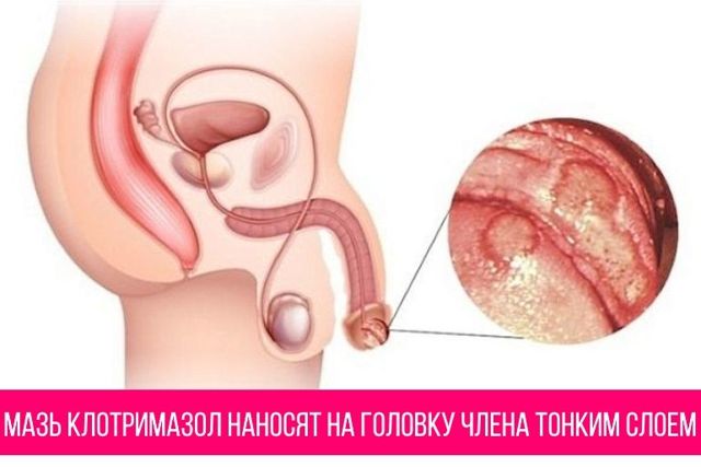 Мазь Клотримазол: инструкция по применению для мужчин при молочнице