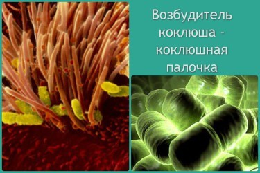 Коклюш у детей: симптомы и лечение