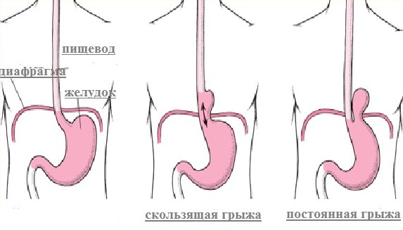 Грыжа пищеводного отверстия диафрагмы (ПОД): что это такое, симптомы, лечение