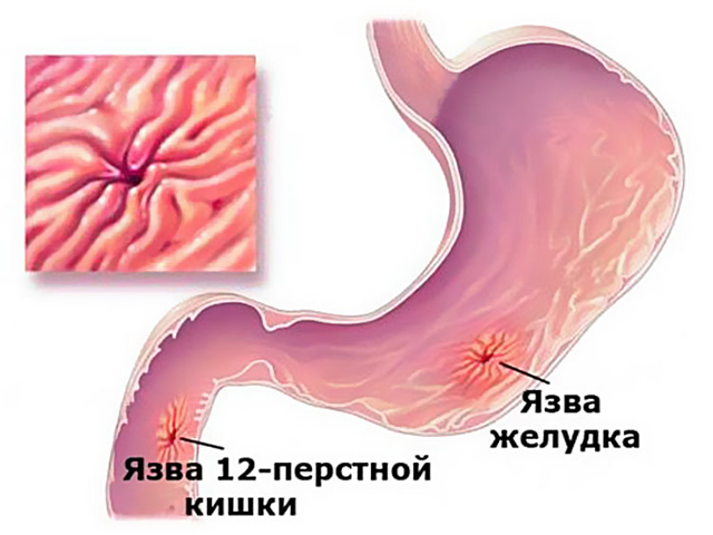 Язва двенадцатиперстной кишки: симптомы и лечение