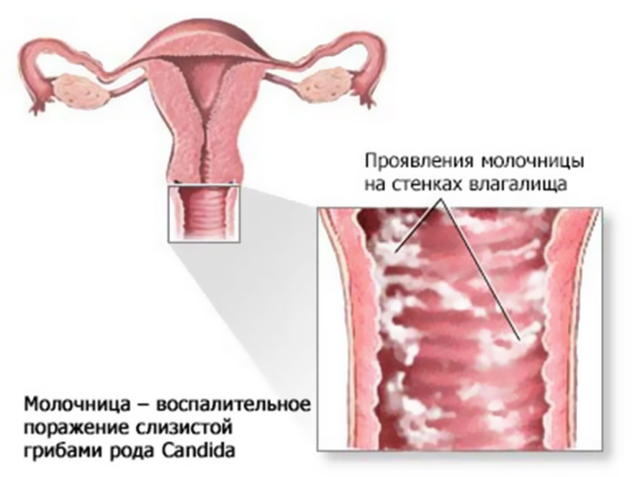 Молочница у женщин - причины, симптомы, лечение, фото, препараты для лечения молочницы у женщин