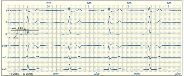 Рубцовые изменения — E-Cardio