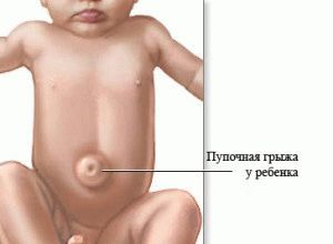 Пупочная грыжа у новорожденных - причины возникновения, симптомы, лечение и профилактика
