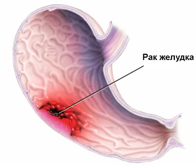 Рак желудка – Болезни онкологии