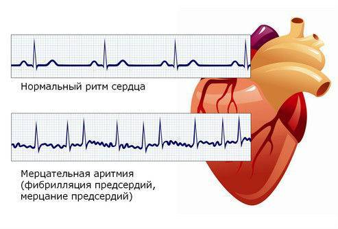 Самые опасные заболевания сердца