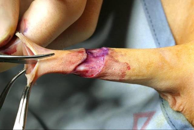 Баланопостит у ребенка: симптомы и лечение недуга