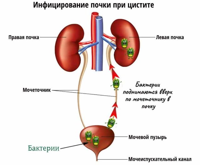 Пиелонефрит - причины, признаки, симптомы и лечение