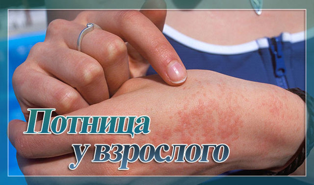 Потница у взрослых - фото, симптомы и лечение проявлений потницы