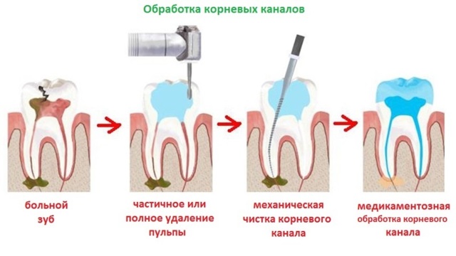 Болит зуб после удаления нерва - причины и лечение, народные средства. Как предотвратить зубную боль после удаления нерва - Автор Екатерина Данилова