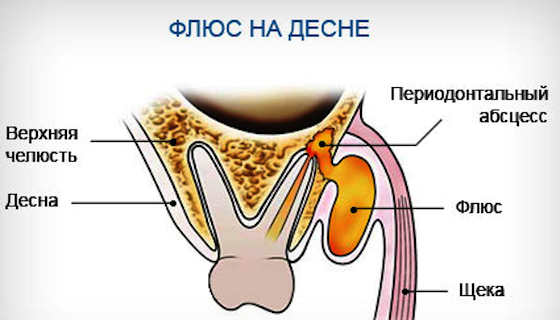 Флюс на десне: лечение, фото, причины возникновения