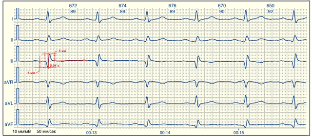 Рубцовые изменения — E-Cardio