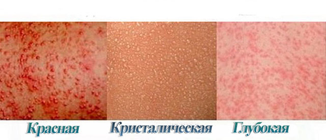 Потница у взрослых - фото, симптомы и лечение проявлений потницы