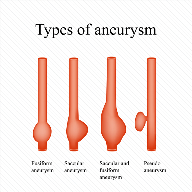 Основные симптомы аневризмы сосудов головного мозга