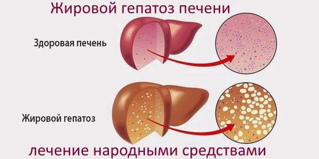 Гепатоз печени - симптомы и лечение народными средствами, диета