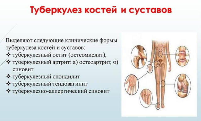Туберкулез костей и суставов - симптомы и первые признаки