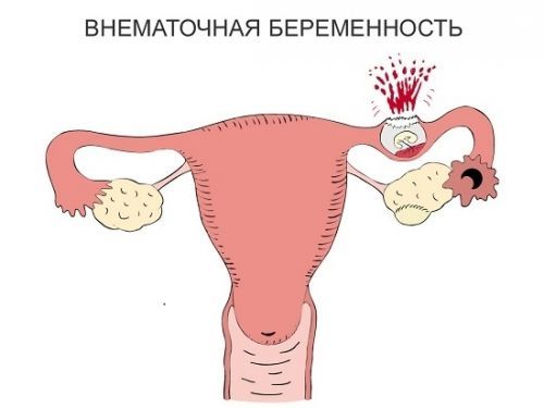 Коричневые выделения при беременности на ранних сроках