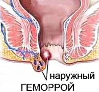 Геморрой наружный лечение и диагностика
