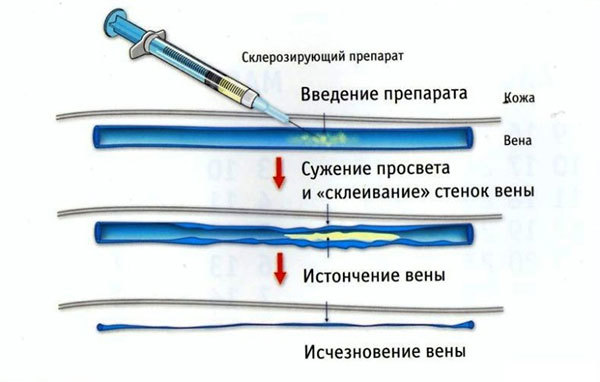 Варикозное расширение вен пищевода – особенности лечения