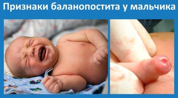 Баланопостит у ребенка: симптомы и лечение недуга