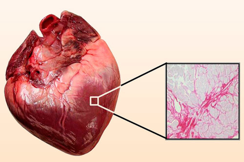 Рубцовые изменения — E-Cardio