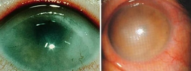 КЕРАТИТ — Большая Медицинская Энциклопедия