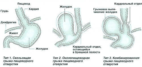 Грыжа пищеводного отверстия диафрагмы (ПОД): что это такое, симптомы, лечение