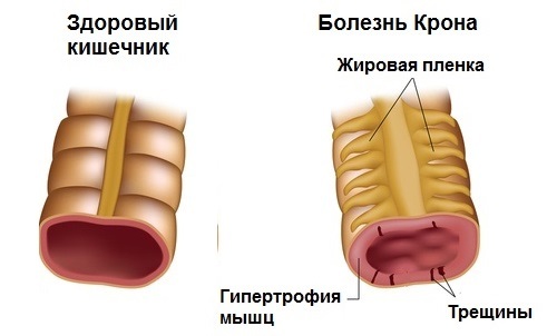 Болезнь Крона - симптомы и лечение у взрослых, причины, диагностика