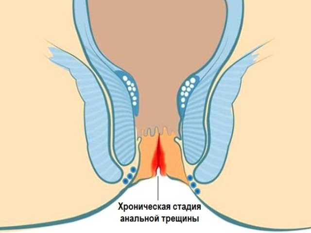 Метилурацил свечи: инструкция по применению и для чего он нужен, цена, отзывы, аналоги