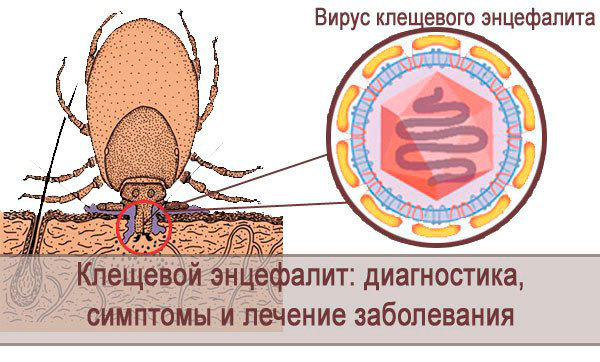 Клещевой энцефалит: диагностика, симптомы и лечение заболевания